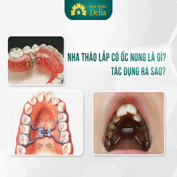 Chỉnh nha tháo lắp có ốc nong có ưu nhược điểm gì? Nha khóa Delia