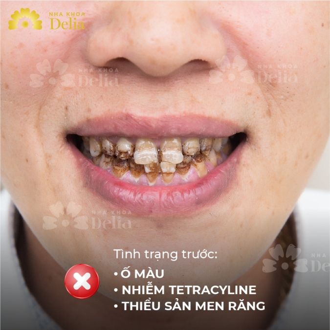 Hỏng Men Răng – Nguyên Nhân Và Giải Pháp Khắc Phục Tốt Nhất