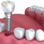 Trồng răng Implant là phương pháp phục hình răng khá phổ biến tại những nước sở hữu công nghệ tiên tiến