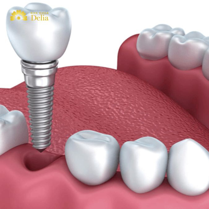 Có nên trồng răng Implant không? Tác hại của trồng răng sứ