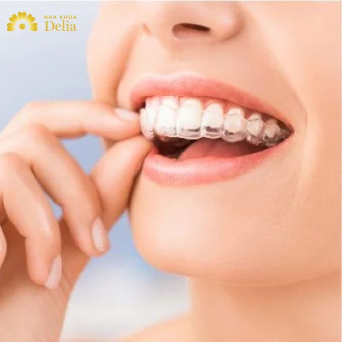 Niềng răng có ảnh hưởng gì không? Tiêu cực hay tích cực