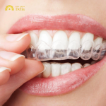 Niềng Răng Invisalign Có Hiệu Quả Không? Giá Bao Nhiêu?
