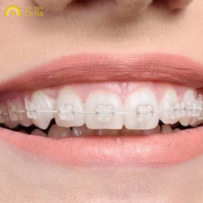 Niềng Răng Mắc Cài Là Gì? Có Bao Nhiêu Loại? Và Những Điều Bạn Cần Biết