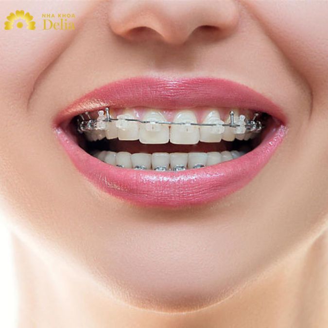 Niềng Răng Mắc Cài Pha Lê Trong Suốt Giá Bao Nhiêu? Có đắt như lời đồn?