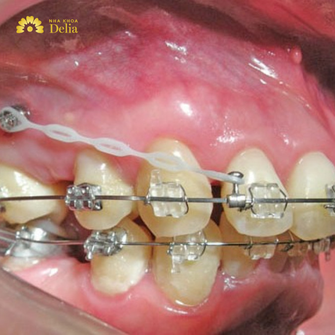 Quy trình niềng răng hô chuẩn quốc tế diễn ra như nào? Nha khoa Delia