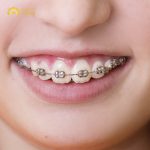 Niềng răng hô bằng mắc cài kim loại được nhiều người lựa chọn bởi mức giá phải chăng, hiệu quả cao