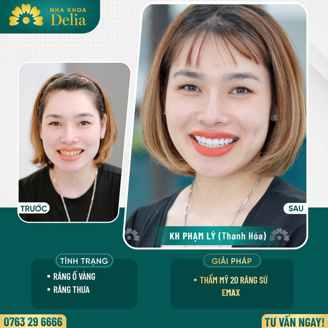 Răng thưa nên niềng răng hay bọc sứ – Đâu là giải pháp nụ cười tốt nhất