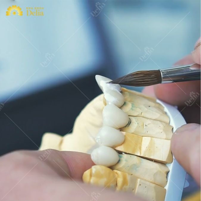 Thẻ bảo hành răng sứ Zirconia và những điều quan trọng cần biết