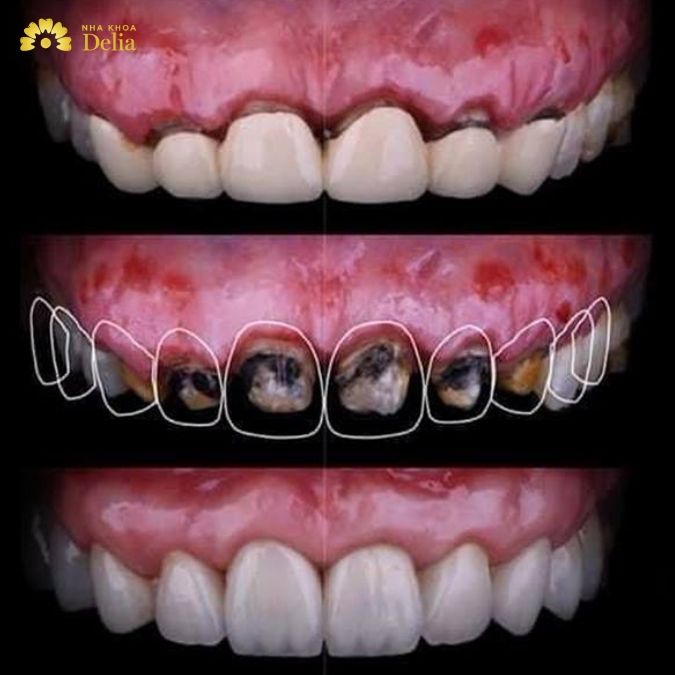 Bọc răng sứ bị đen nướu do sử dụng sứ kim loại giá rẻ?