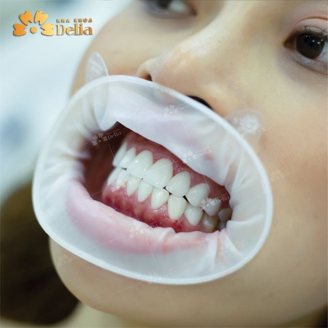 Làm răng sứ bị hôi miệng nguyên nhân chính do đâu?
