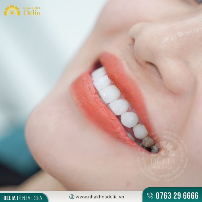 Cầu răng sứ là gì? Khi nào nên làm cầu răng sứ? – Nha khoa Delia