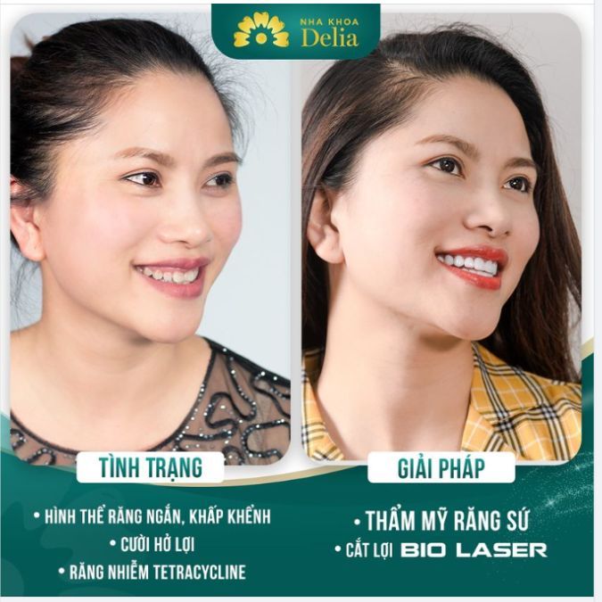 Cười hở lợi phải làm sao? 6 cách điều trị cười hở lợi hiệu quả nhất