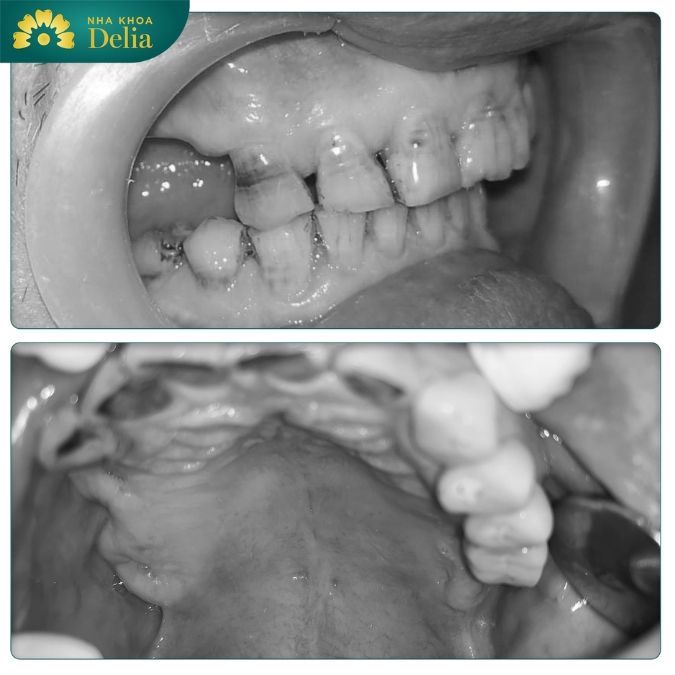 Ghép xương răng là gì? tại sao cần phải ghép xương trước khi cấy implant