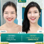 Tướng số phụ nữ cười hở lợi