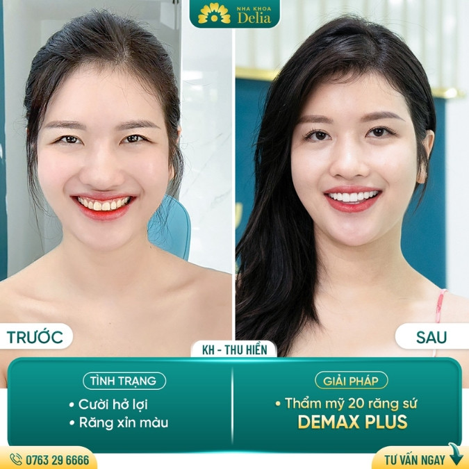 Phẫu thuật cười hở lợi ở đâu tốt nhất TPHCM? – Top 8 địa chỉ nha khoa uy tín