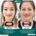 Những lưu ý trước khi trồng răng Implant