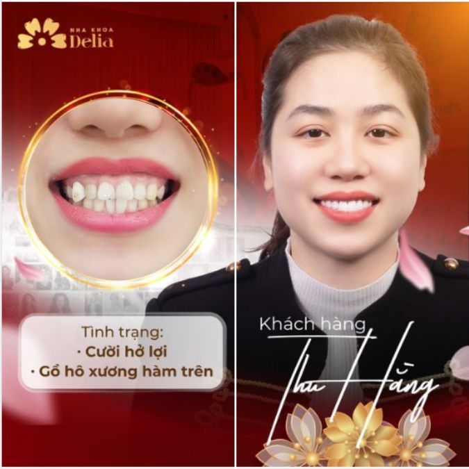 Phương pháp chữa cười hở lợi không phẫu thuật có hiệu quả không?
