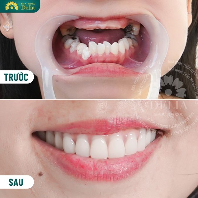 Transformations with All on 6 dental Implants before and after