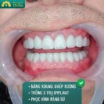 Trồng răng Implant có bị hôi miệng không