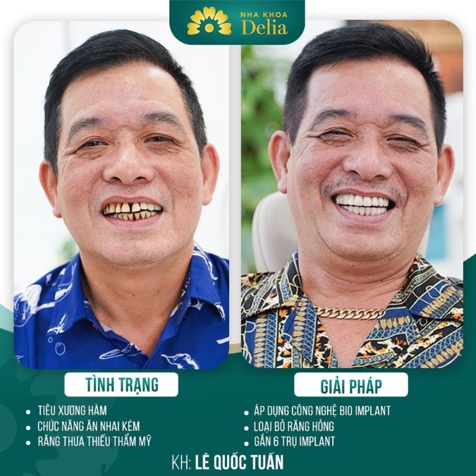 Trồng răng Implant có đau không? Có ảnh hưởng đến sức khỏe không?