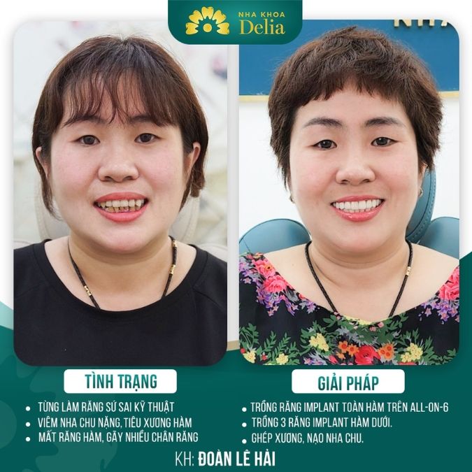 Trồng răng Implant loại nào tốt? Top 4 loại tốt nhất để trồng Implant