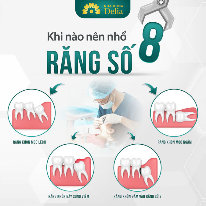 Nhổ răng khôn có nguy hiểm không? 3 Lưu ý để tránh chứng nguy hiểm