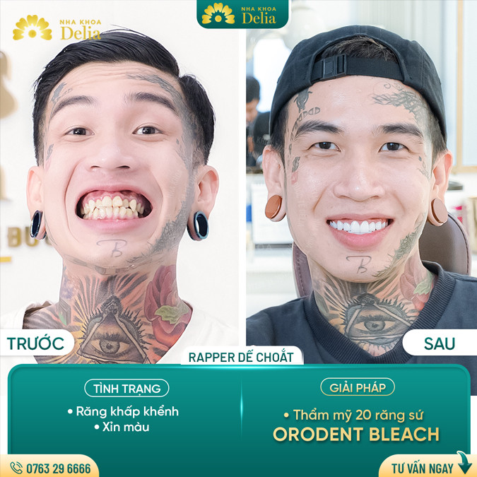 4 Cách xử lý răng hô đẹp tự nhiên, nụ cười tự tin – Nha khoa Delia