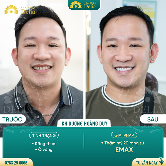 Răng cửa thưa phải làm sao? Tướng số người răng cửa thưa