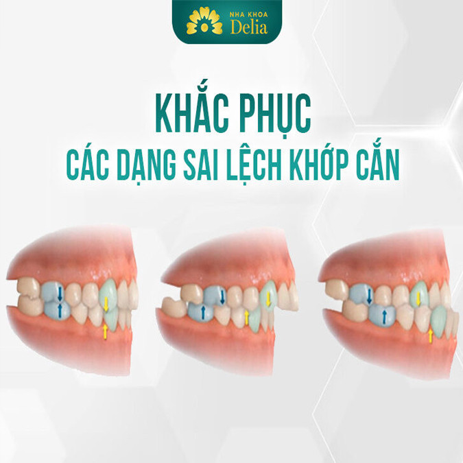 Các dạng sai lệch khớp cắn 123 – Cách khắc phục hiệu quả nhất