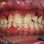 Viêm nướu hoại tử lở loét cấp tính nguy hiểm như thế nào? Nha khoa Delia