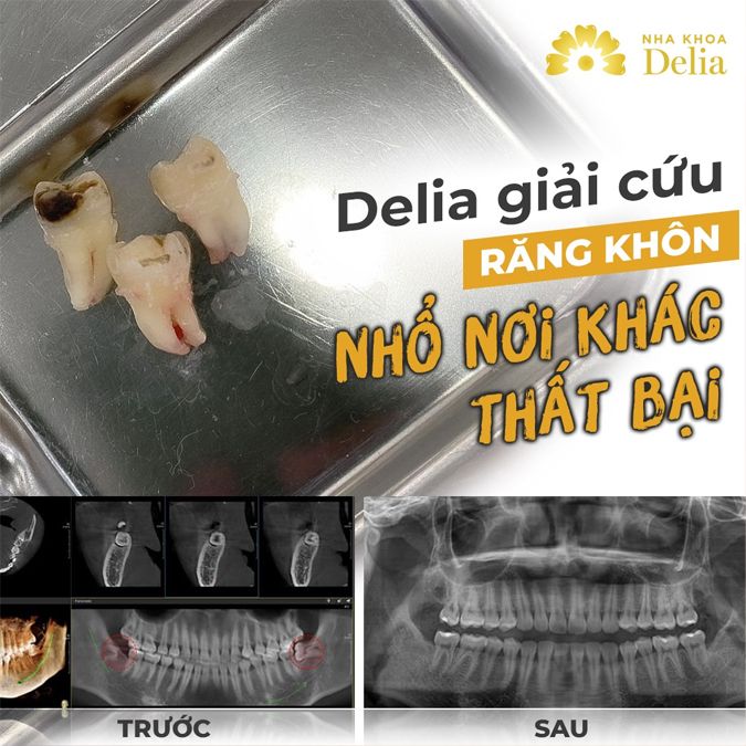 Nhổ 234 răng khôn cùng 1 lúc có sao không? – Nha khoa Delia