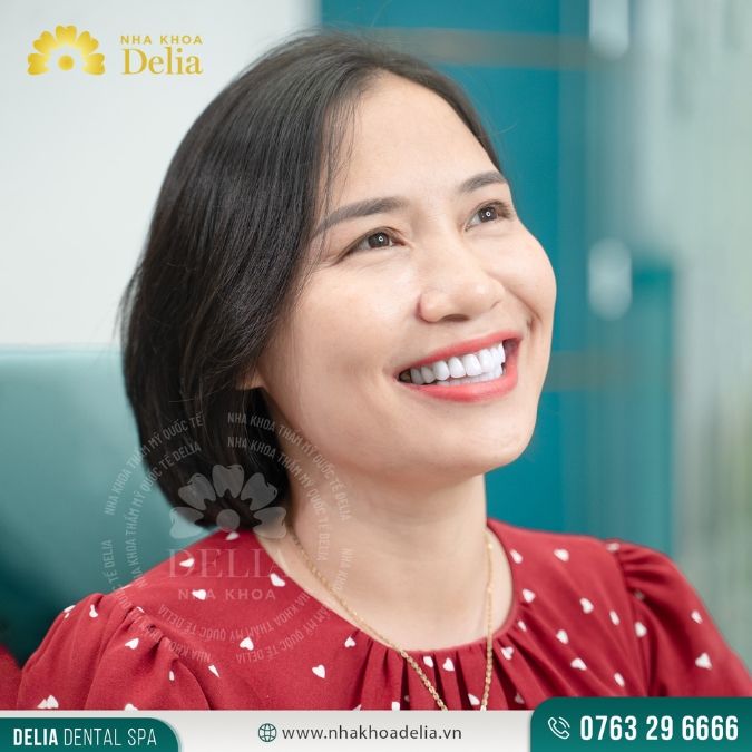 Bọc răng sứ bị hở – Dấu hiệu, nguyên nhân và cách khắc phục ngay