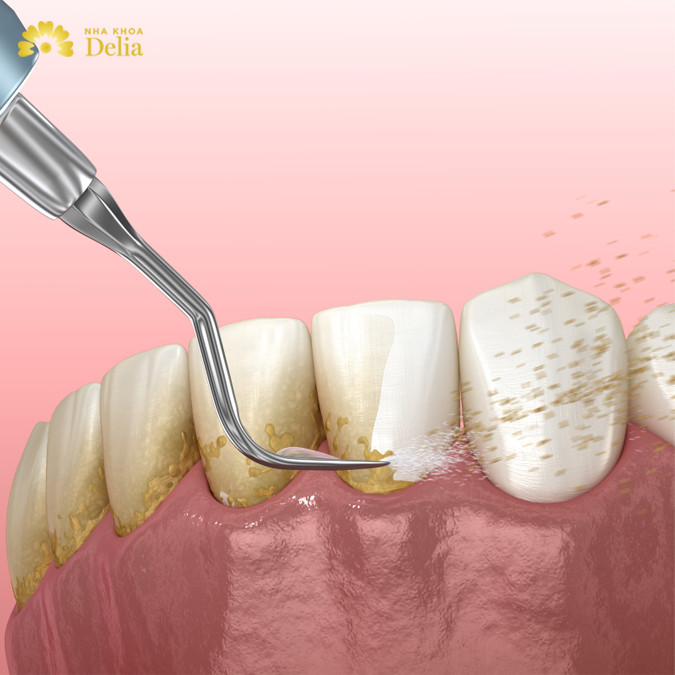 [Cập nhật] Giá cạo vôi răng – Địa chỉ cạo vôi răng uy tín, an toàn