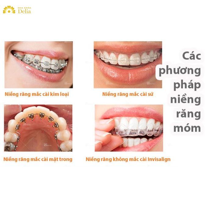 Kinh nghiệm niềng răng móm, 3 yếu tố quan trọng khi niềng răng móm