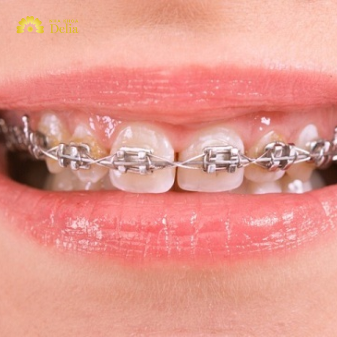 Giải đáp: 25 tuổi niềng răng được không, hiệu quả như thế nào?