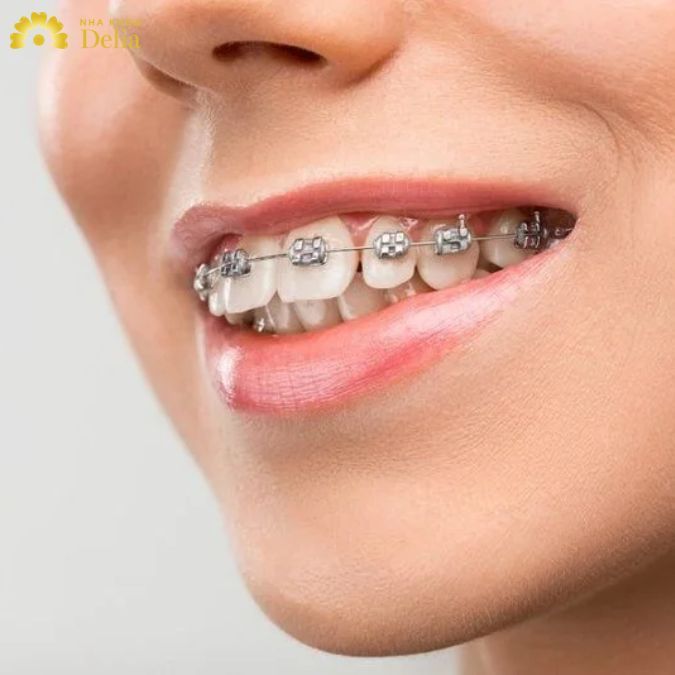 Niềng răng mắc cài loại nào tốt nhất? 3 Tiêu chí quan trọng chọn niềng răng