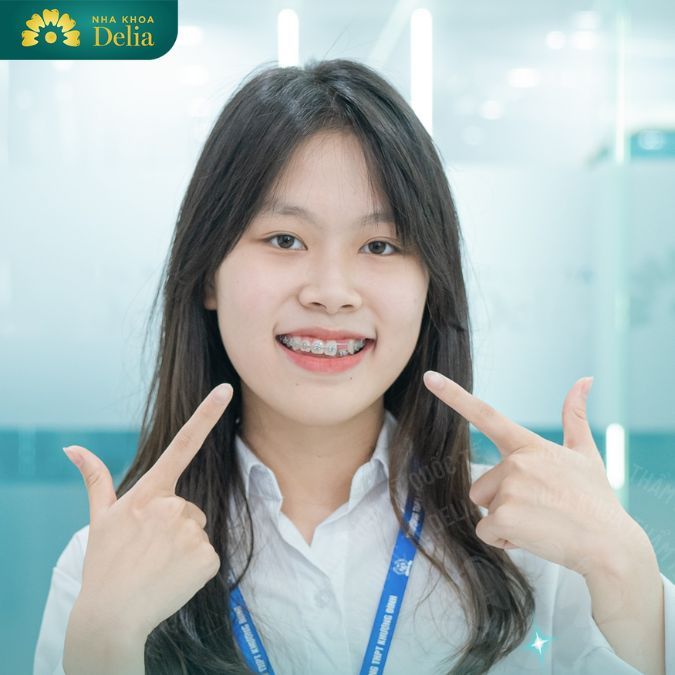 7 Giai đoạn trong quy trình niềng răng bạn phải trải qua – Giai đoạn nào quan trọng nhất?