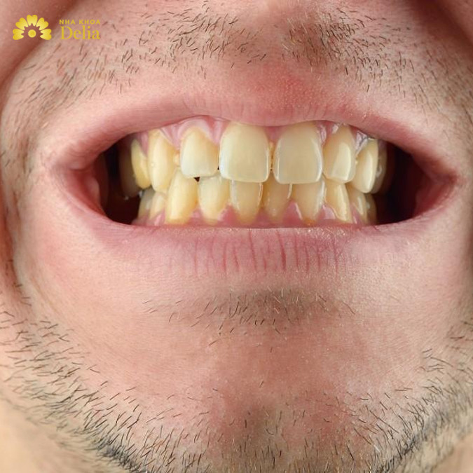 Răng xỉn màu – Nguyên nhân, cách khắc phục màu răng tự nhiên tốt nhất