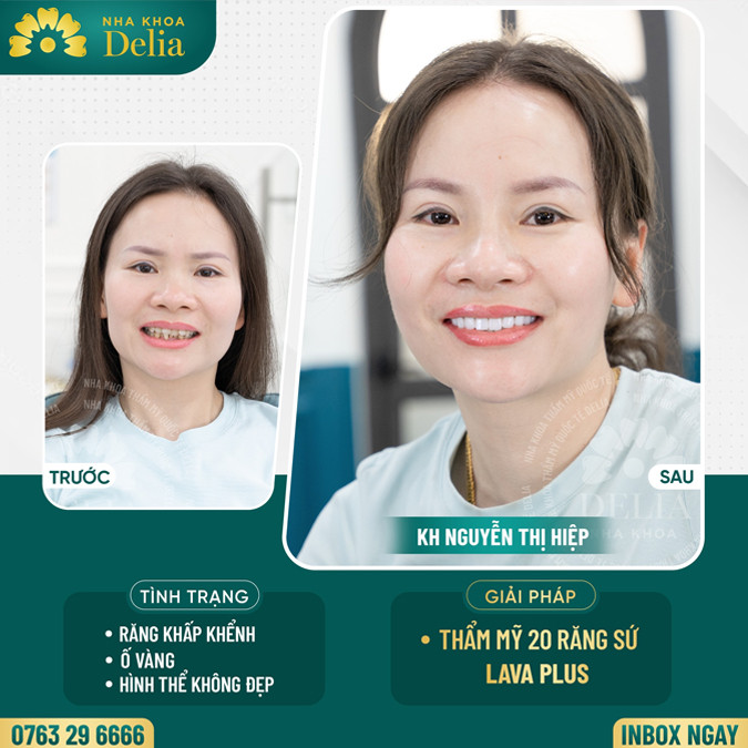 Răng khấp khểnh nên làm gì? niềng răng có là phải giải pháp tốt nhất?