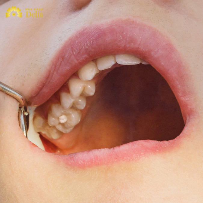 Răng khôn mọc lệch ra má hàm trên, hàm dưới có nguy hiểm? Nha khoa Delia