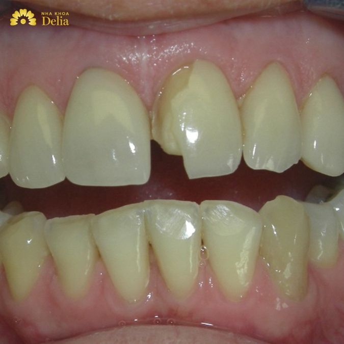 Răng Sứ Bị Bể, Rơi, Lệch Khớp Cắn Phải Làm Sao?