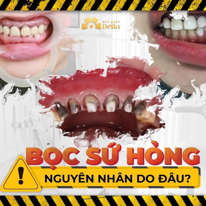 Răng sứ kim loại có tốt không? Giá bao nhiêu? Cập nhật tháng 3/2025