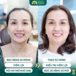 Thẩm mỹ răng sứ