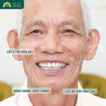 Trồng răng Implant cho người già