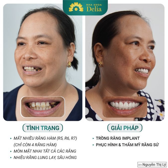 Tuổi thọ của răng Implant là bao lâu? Cách chăm sóc răng Implant bền nhất