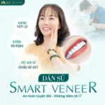 Sau khoảng 2 -3 ngày, bác sĩ sẽ gắn thử mặt dán sứ Veneer lên răng