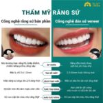 Nên làm răng sứ hay dán veneer