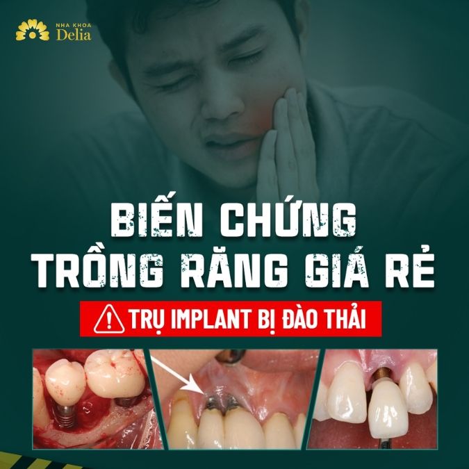 Hậu quả của việc cắm trụ Implant sai kỹ thuật bạn nhất định phải biết
