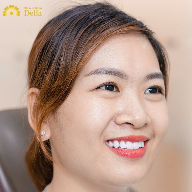 Những điều bạn cần biết khi cắt lợi thẩm mỹ – Nha khoa Delia