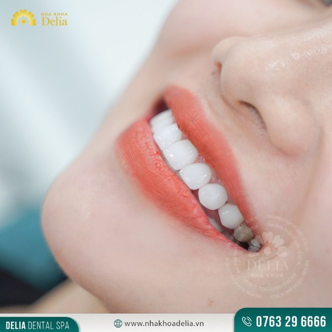 Răng sứ bị rớt ra chủ yếu do nguyên nhân nào?
